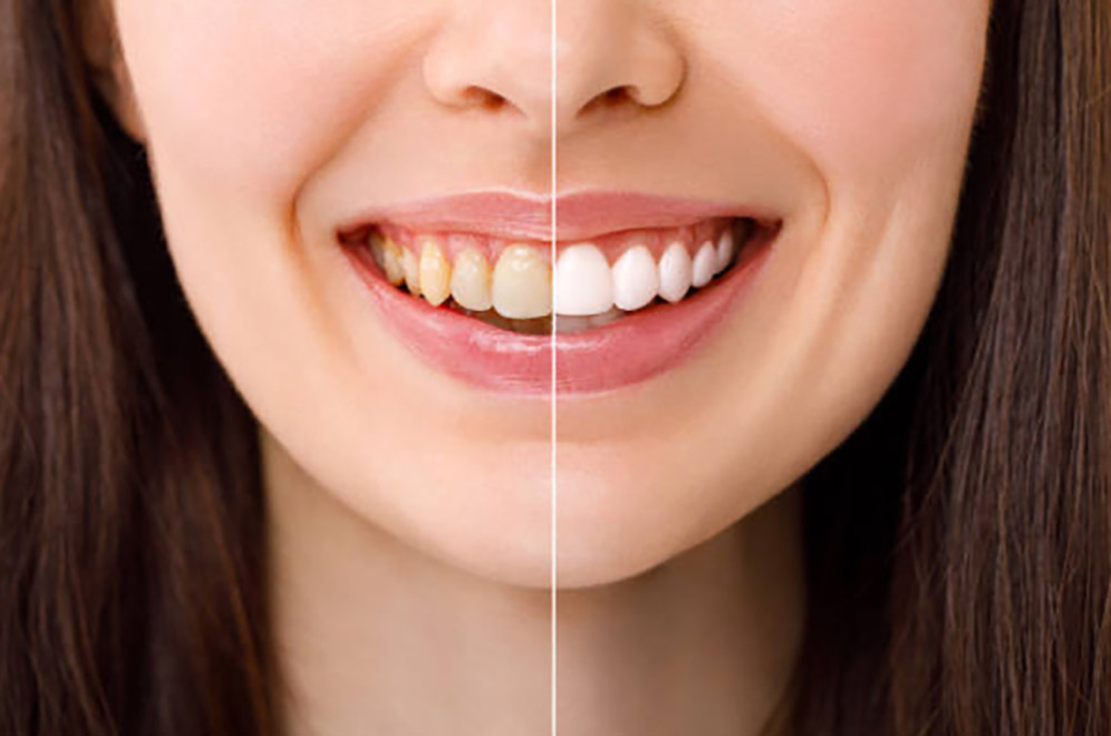 ホワイトニングで1番キレイに見えるポイントは？
