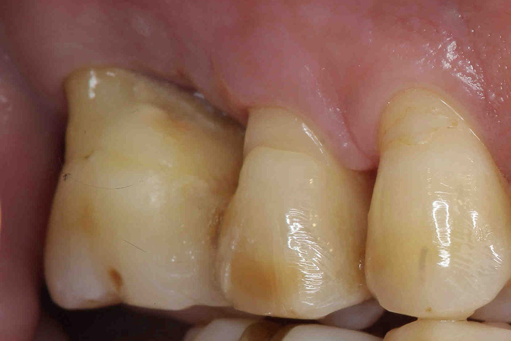 ルートアンプテーション