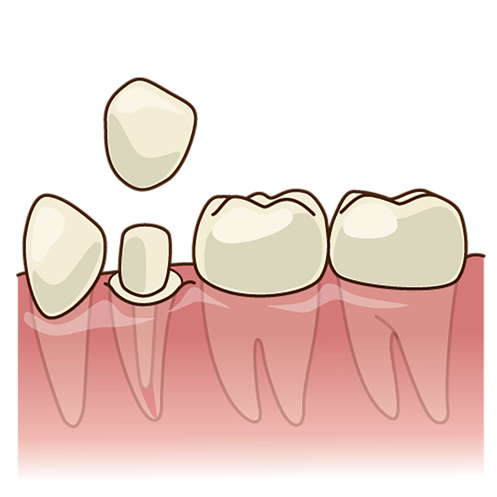 ファイバーコア