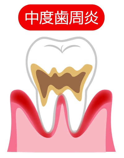 中等度歯周病