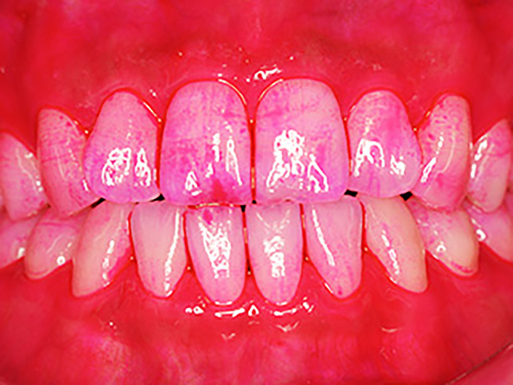 プラーク（歯垢）の染め出し