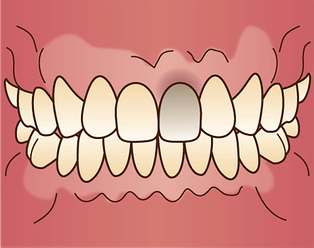 ウォーキングブリーチとは